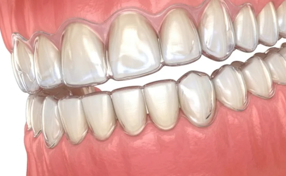 Ilustração de clareamento dental com moldeira
