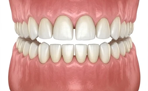 Ilustração de sorriso com facetas